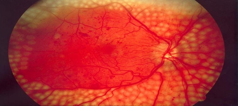 retinopatia